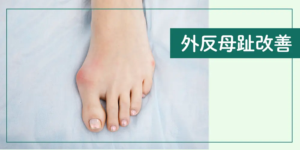 外反母趾